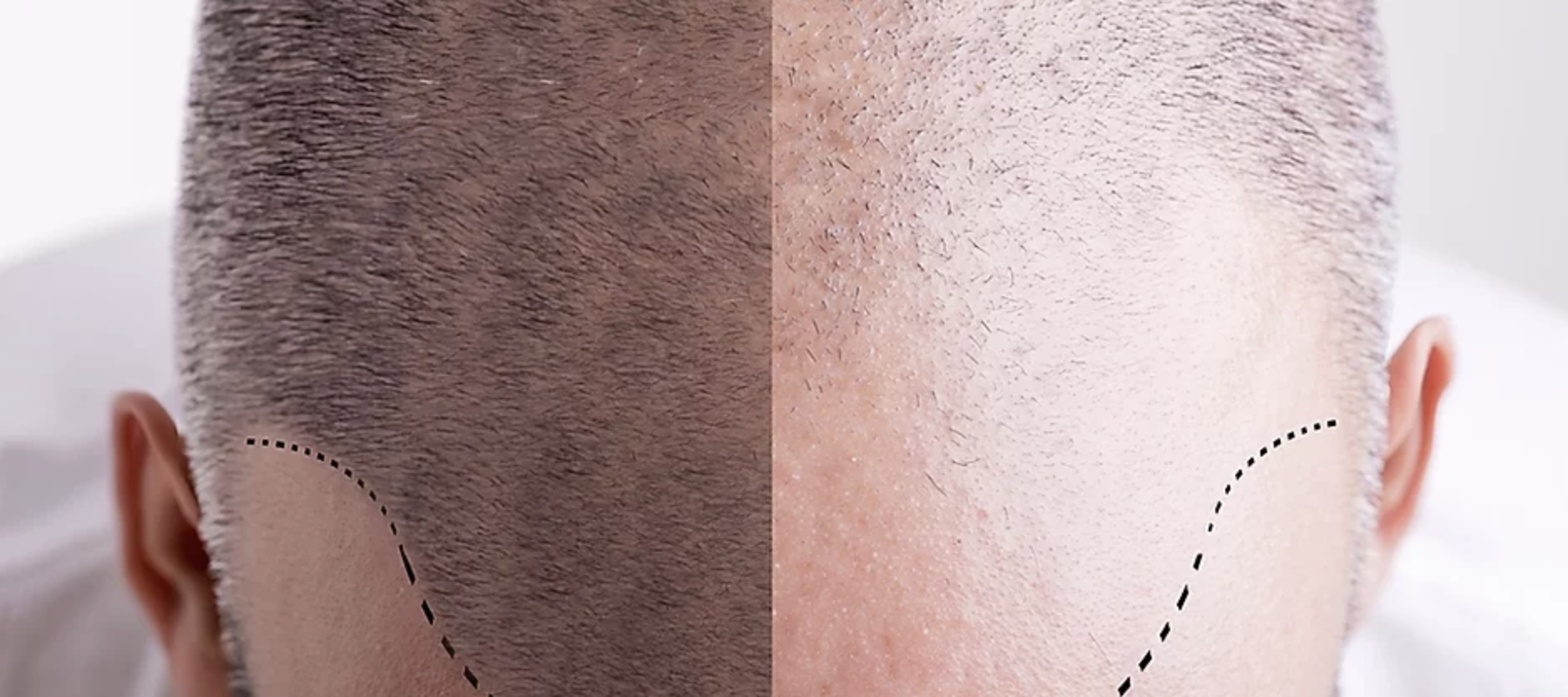SCALP PİGMENTASYON
